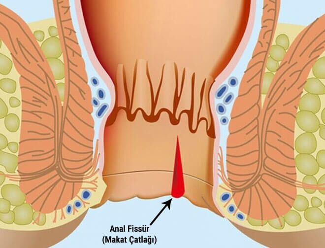Nima uchun ayollar anal jinsiy aloqani yoqtirmaydilar (ayollar forumi) Qanday qilib va nima bilan onanizm qilish kerak